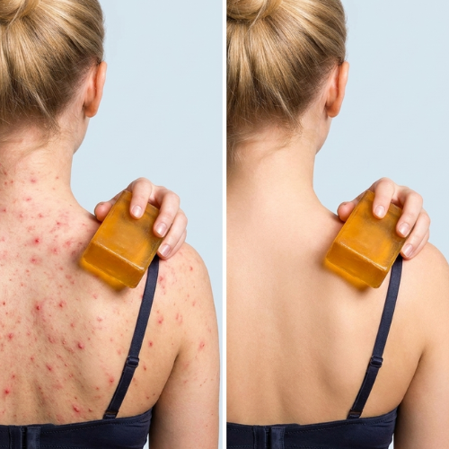 Body Acne Bar