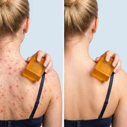 Body Acne Bar