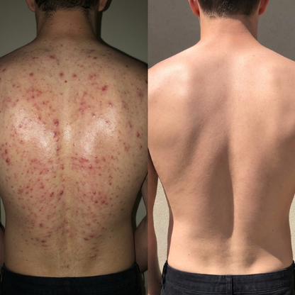 Body Acne Bar